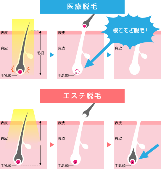 医療脱毛とエステ脱毛の違い